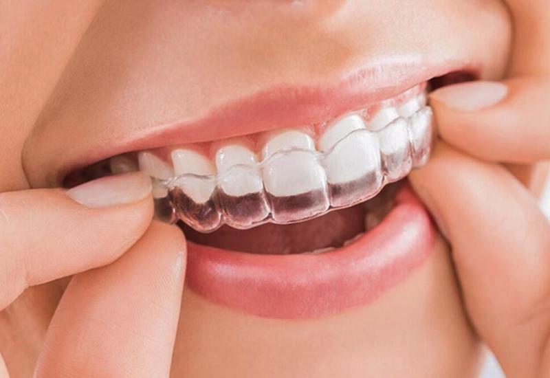 niềng răng 18 tuổi