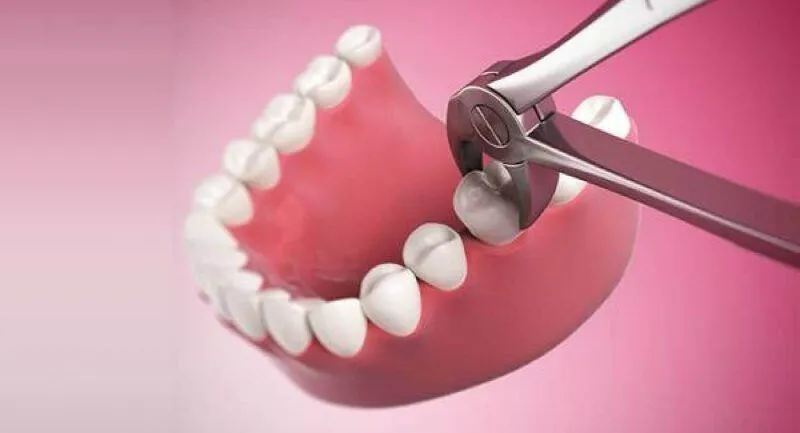 khi nào không nên nhổ răng khôn