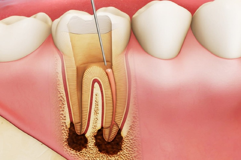 Khi nào phải lấy tủy răng sữa