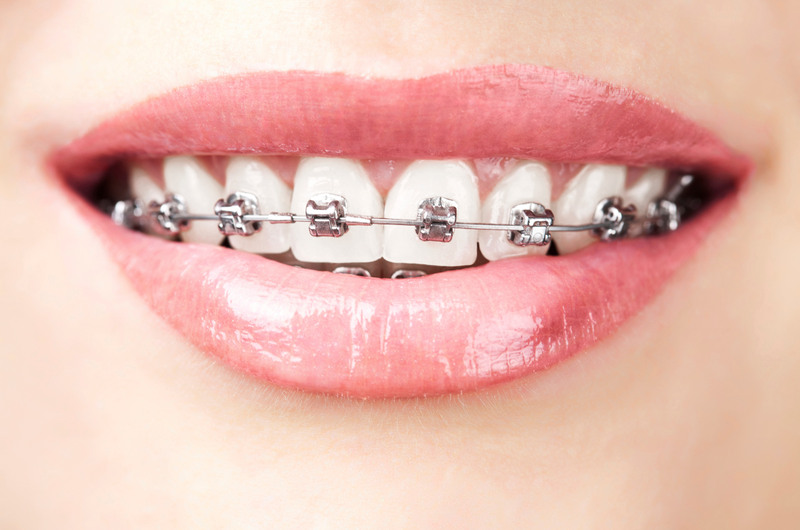 Các giai đoạn trong quá trình niềng răng