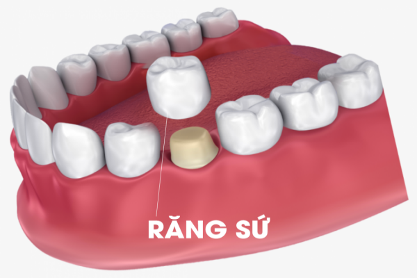 rang-su-1