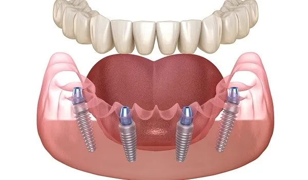 trong-rang-implant-all-on-4