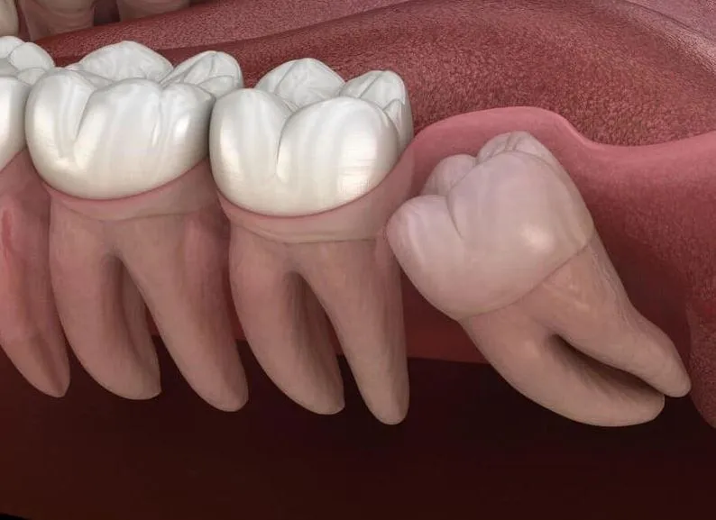 rang-moc-ngam-co-can-nho-khong-1