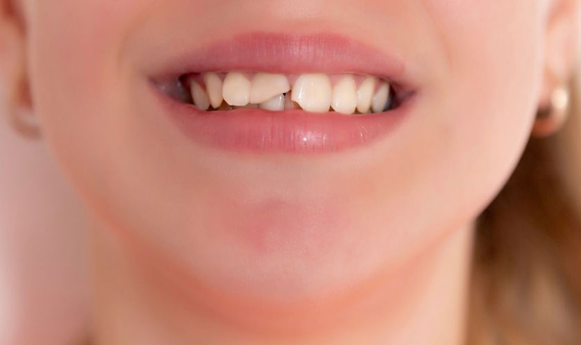 Giải Pháp Khi Bạn Bị Mẻ Răng