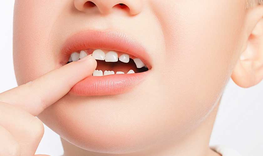 Quy Trình Thay Răng Diễn Ra