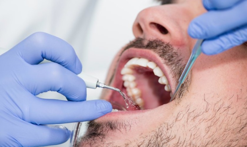 lấy cao răng có hại gì không