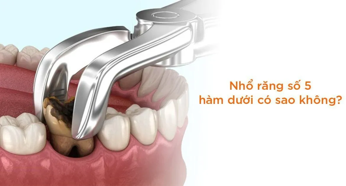 thay răng số 5 hàm dưới