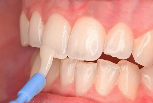 răng có mảng bám ố vàng