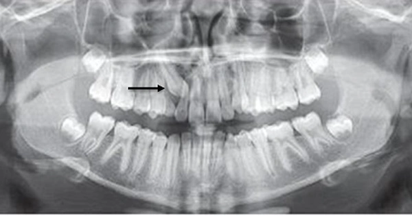răng mọc ngầm có cần nhổ không
