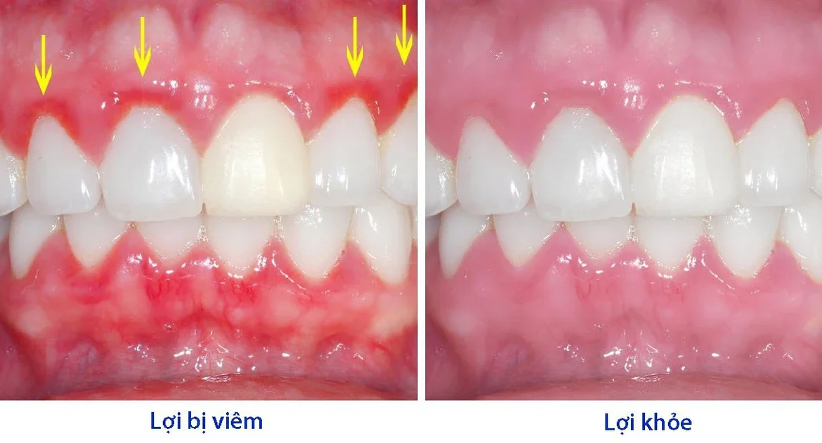 viêm lợi răng hàm