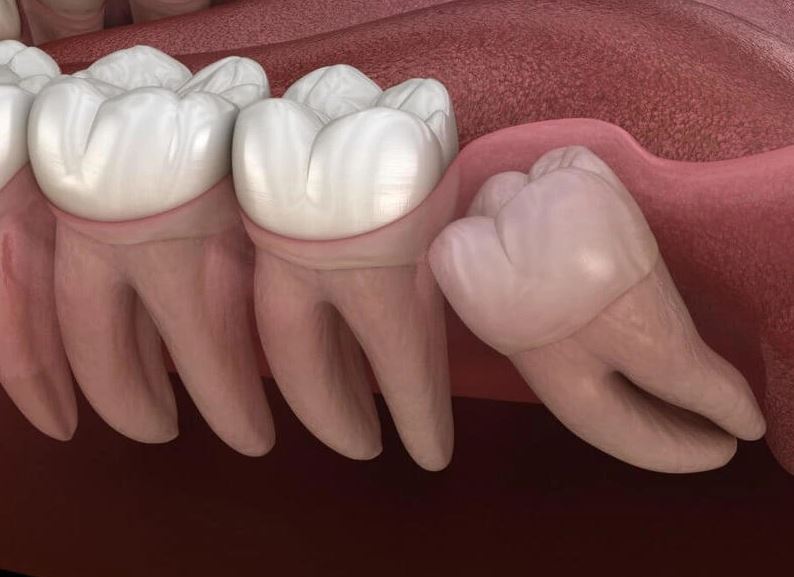 dấu hiệu răng mọc ngầm