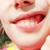 hình ảnh viêm nướu răng ở trẻ