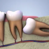 răng số 8 mọc lệch