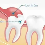 cách để răng khôn mọc thẳng