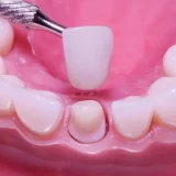 lắp răng tạm có ăn được không