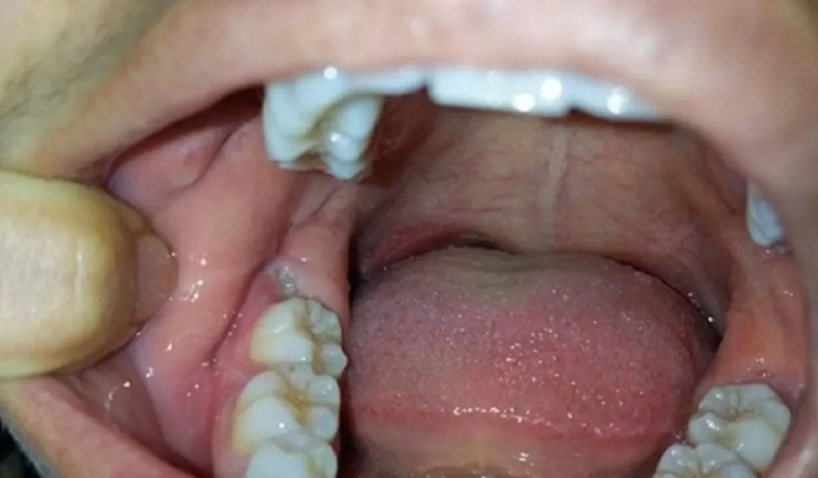 mọc răng hàm dưới trong cùng