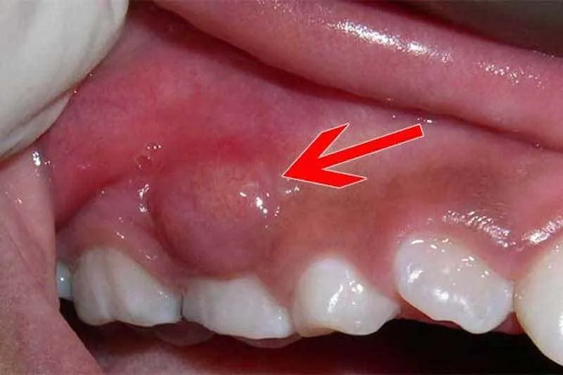 áp xe răng có nguy hiểm không