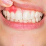 thuốc trị áp xe răng