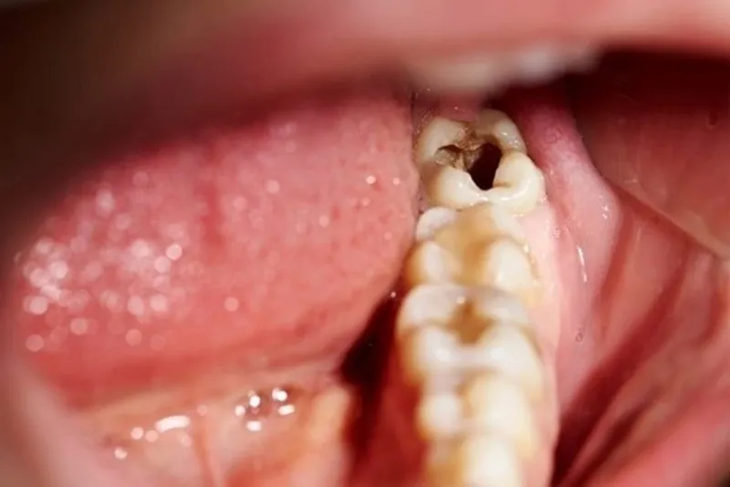 có nên trồng răng số 8